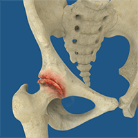 Rheumatoid Arthritis