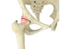 Femoroacetabular Impingement