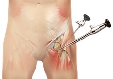 Hip Arthroscopy