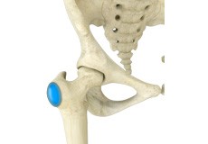 Hip Bursitis