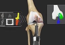 MAKO<sup>®</sup> Robotic Total Knee Replacement
