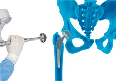 MAKO<sup>®</sup> Robotic Total Hip Replacement