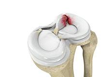 Meniscal Injuries