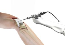 MAKO<sup>®</sup> Robotic Partial Knee Replacement